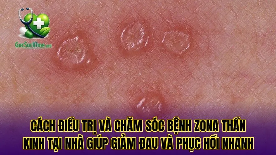 Cách điều trị và chăm sóc bệnh zona thần kinh tại nhà giúp giảm đau và phục hồi nhanh