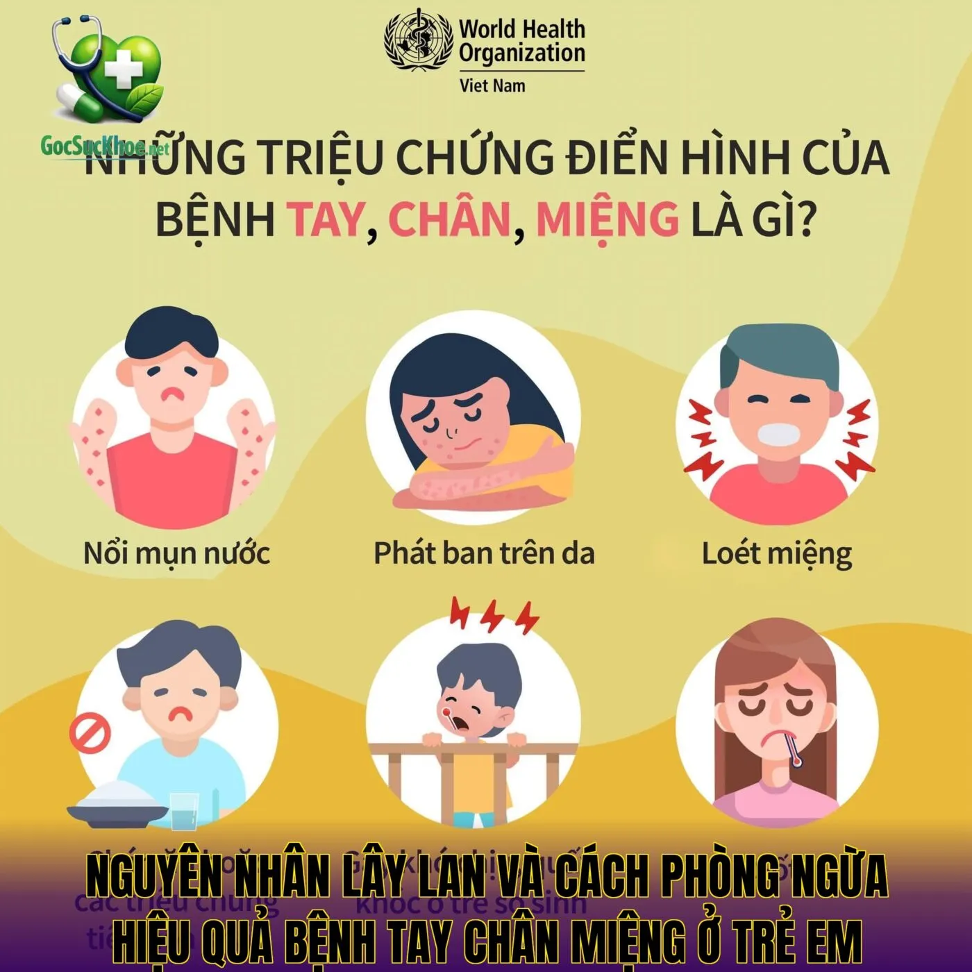 Nguyên nhân lây lan và cách phòng ngừa hiệu quả bệnh tay chân miệng ở trẻ em