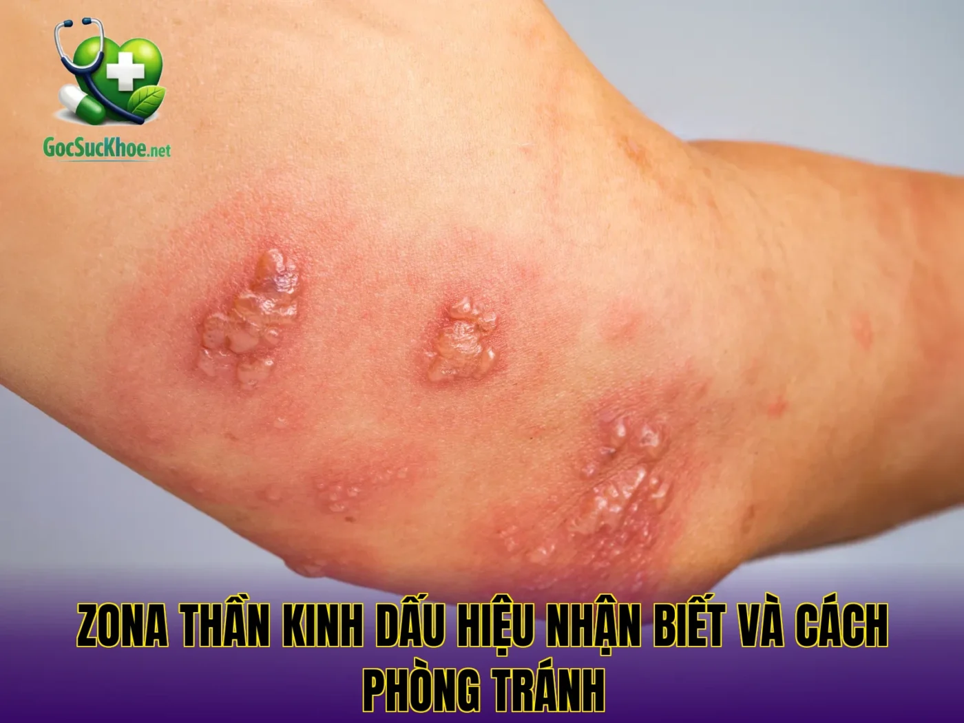 Zona thần kinh dấu hiệu nhận biết và cách phòng tránh