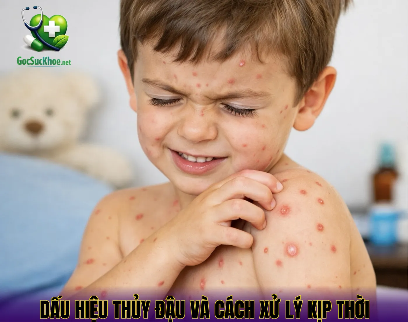 Dấu hiệu thủy đậu và cách xử lý kịp thời