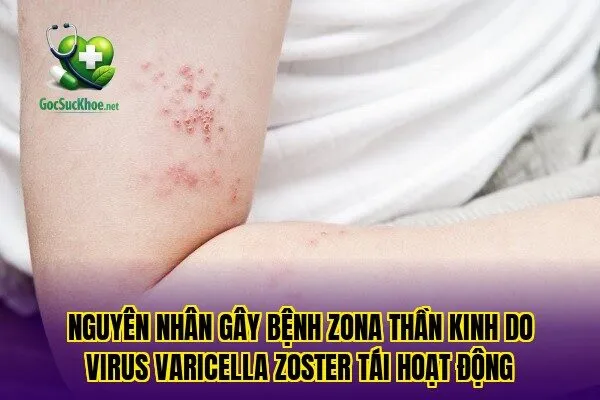 Nguyên nhân gây bệnh zona thần kinh do virus varicella zoster tái hoạt động