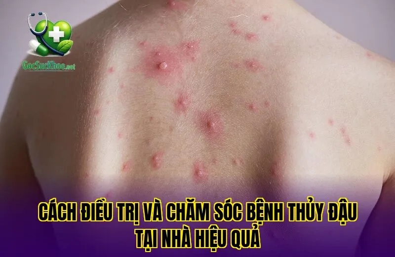 Cách điều trị và chăm sóc bệnh thủy đậu tại nhà hiệu quả