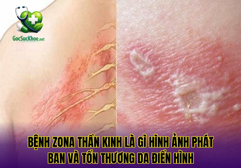 Bệnh zona thần kinh là gì hình ảnh phát ban và tổn thương da điển hình