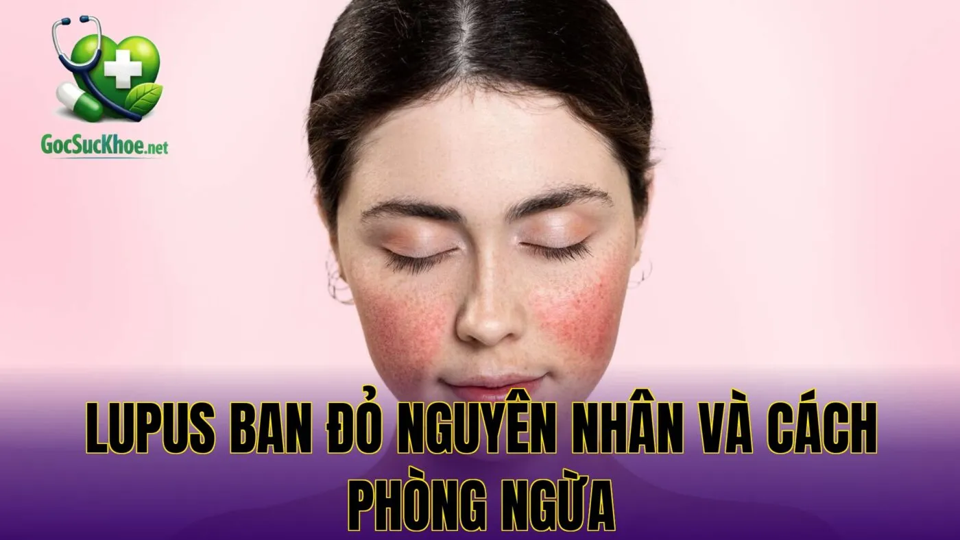 Lupus ban đỏ nguyên nhân và cách phòng ngừa