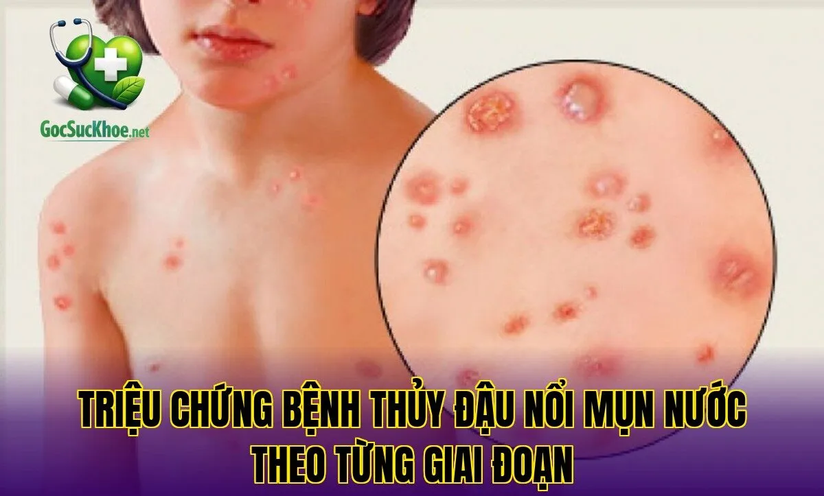 Triệu chứng bệnh thủy đậu nổi mụn nước theo từng giai đoạn
