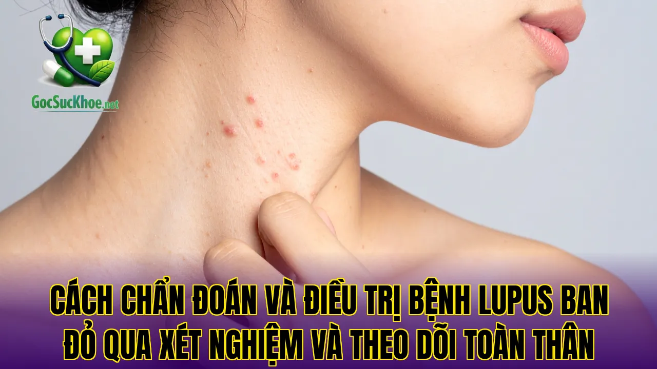 Cách chẩn đoán và điều trị bệnh lupus ban đỏ qua xét nghiệm và theo dõi toàn thân
