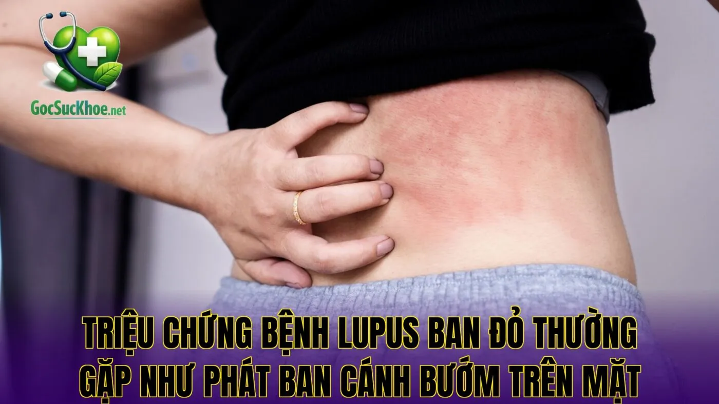 Triệu chứng bệnh lupus ban đỏ thường gặp như phát ban cánh bướm trên mặt
