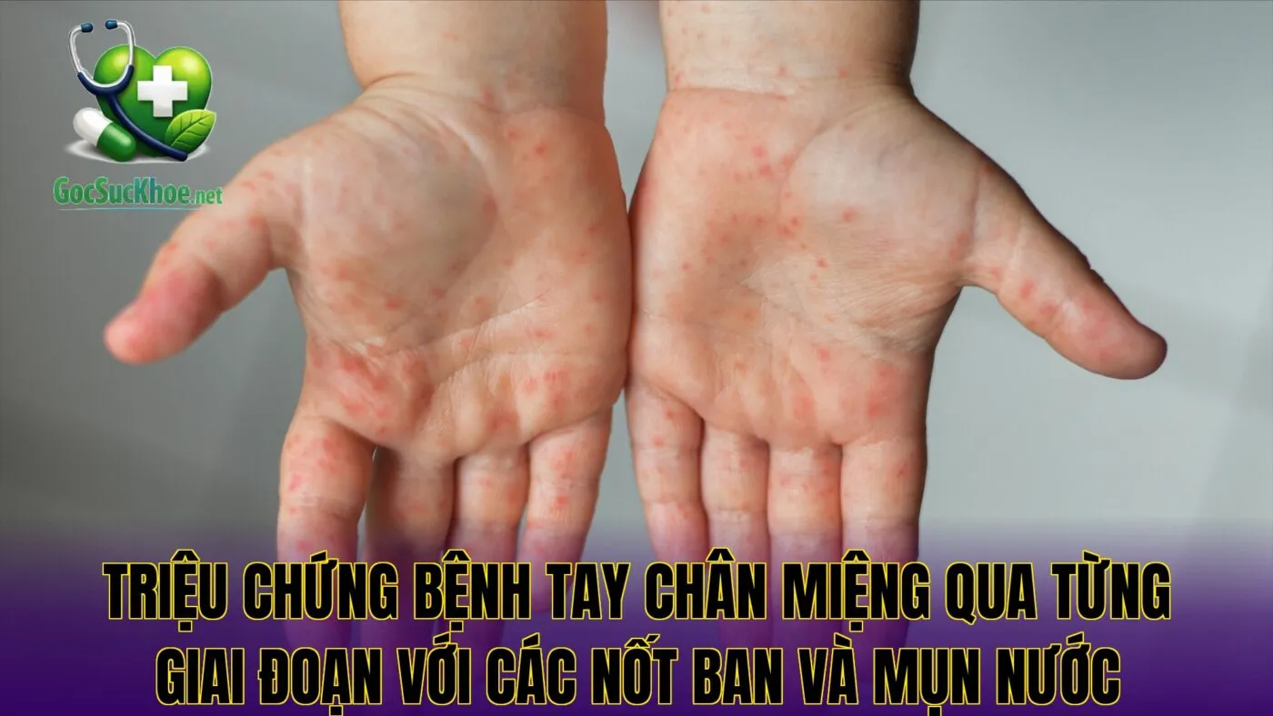 Triệu chứng bệnh tay chân miệng qua từng giai đoạn với các nốt ban và mụn nước