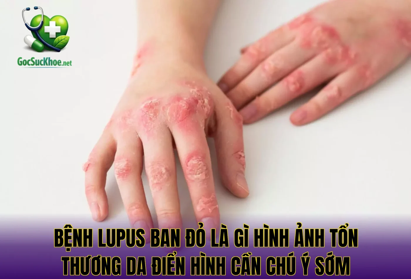Bệnh lupus ban đỏ là gì hình ảnh tổn thương da điển hình cần chú ý sớm