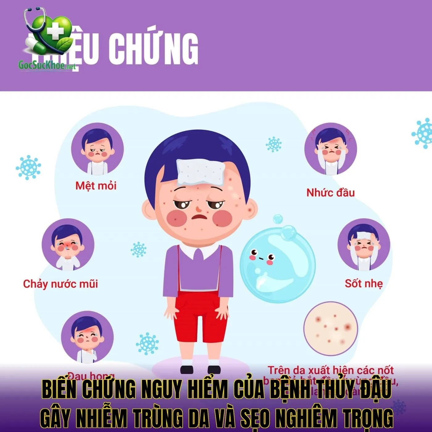 Biến chứng nguy hiểm của bệnh thủy đậu gây nhiễm trùng da và sẹo nghiêm trọng