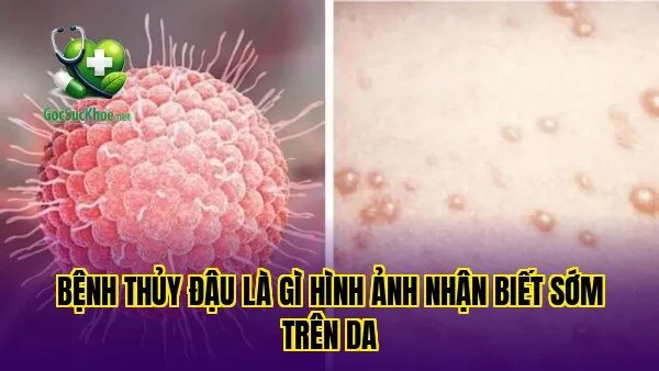Bệnh thủy đậu là gì hình ảnh nhận biết sớm trên da